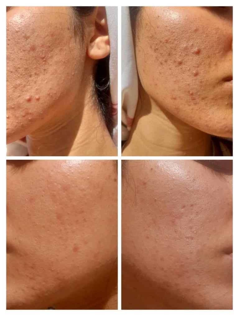 Before and after comparison of acne treatment on facial skin showing reduction in breakouts and improved complexion